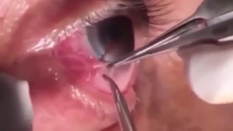 Surgery eyes