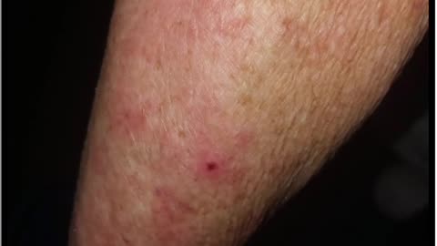 Healing a Bad Skin Rash with Apple Cider Vinegar and Hydrogen Peroxide