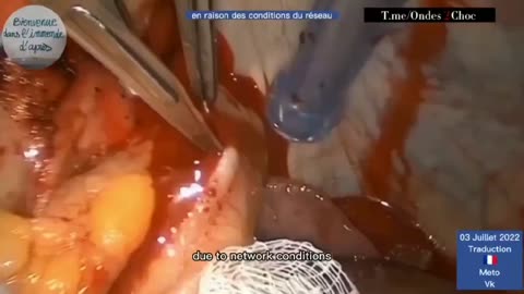 The Surgical Removal of a Complex Blood Clot Directly from a Beating Human Heart