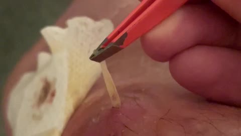 Removing a Larva That Grew in my Leg for 5 Weeks