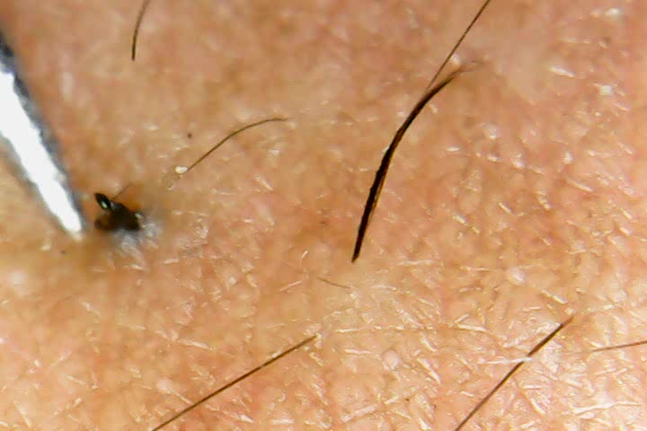 removing-the-horrible-ingrown-hair-root