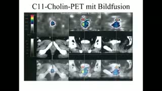 DR. DANA FLAVIN DISCUSSED CHOLINE C-11 PET SCANS FOR PROSTATE CANCER