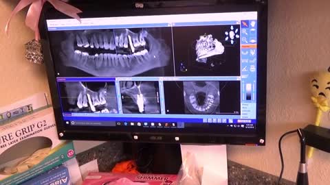 HILLOCK Dental Video Series